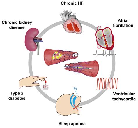 Case Report Renal Hypertension at Peter French blog