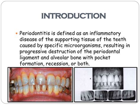 Ppt Aggressive Periodontitis Powerpoint Presentation Free Download