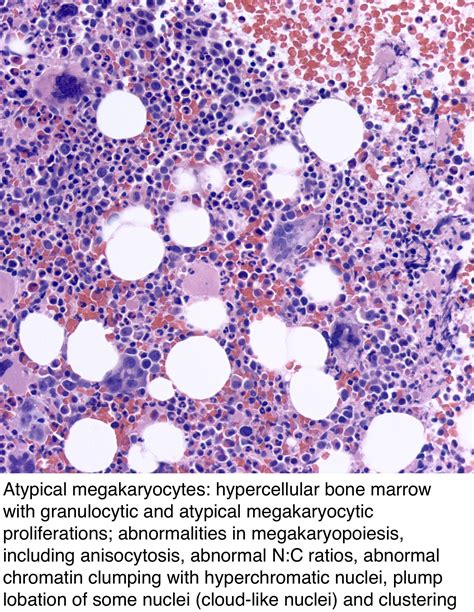 Pathology Outlines Primary Myelofibrosis