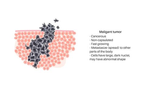 Vector ilustración aislada de tumor maligno en tejido sano propagación