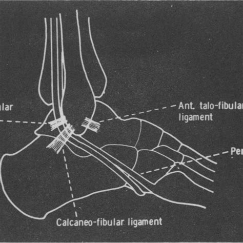 Stress X Ray Of Ankle Revealing Anterior Instability Right Ankle