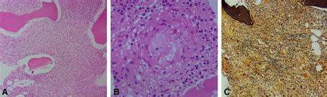 A B Hematoxylin And Eosin Staining ×100 And ×400 Bone Marrow Biopsy