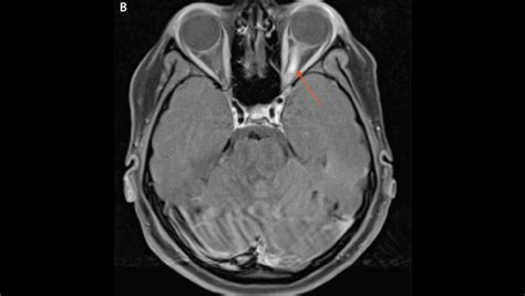 Optic Nerve Lesions - The Neurology Hub