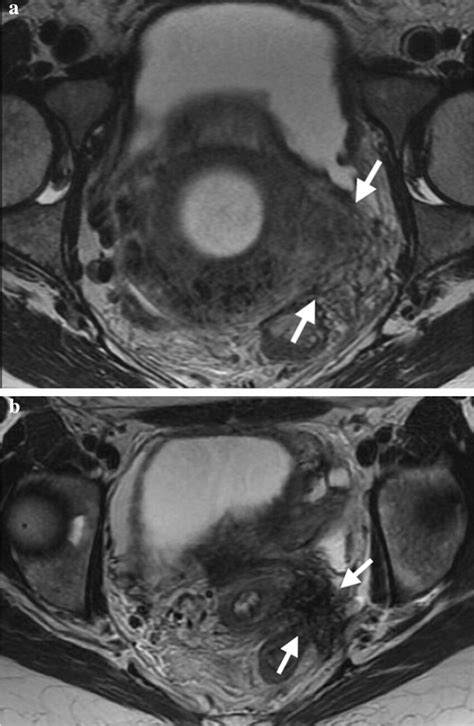 32 Year Old Woman With Evolution Of Deep Endometriosis In Uterosacral