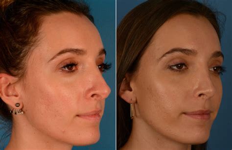 Revision Rhinoplasty Photos Naples Fl Patient