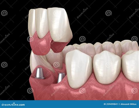 Frontal Teeth Bridge Supported By Implants Medically Accurate D