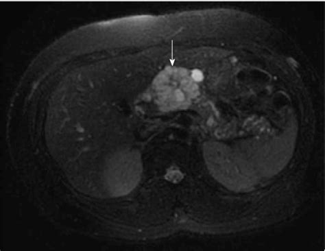 Figure From Clinical Approach To Incidental Pancreatic Cysts