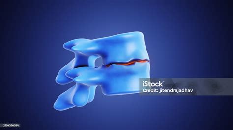 Degeneration With Osteophyte Formation Disc Disease Affecting The Spine ...