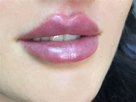 Russian Lips innovative Technik zur Lippenvergrößerung