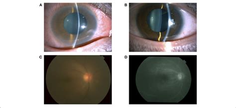 A Slit Lamp Examination Showing Conjunctival Hyperemia And Anterior Download Scientific