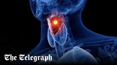 Laryngeal Larynx Cancer A Comprehensive Guide