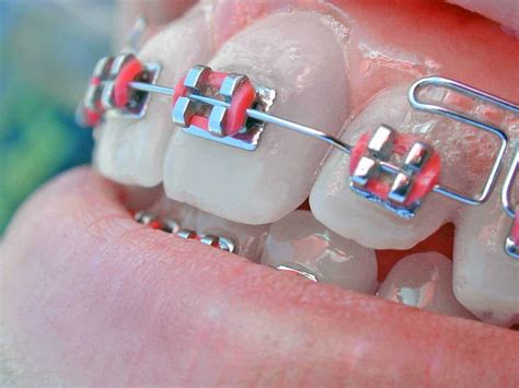 Which Is The Right Type Of Conventional Braces In Toronto On