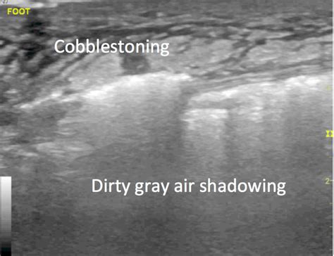 Necrotizing Soft Tissue Infection Image 2 Ultrasonido En Zonas De