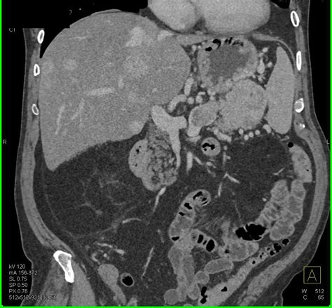 Pancreatic Neuroendocrine Tumor PNET Tail Of The Pancreas With Liver