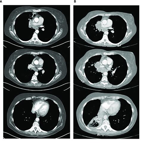 Shows The Ct Scans Of A 61 Year Old Patient With Nsclc A Shows 3 Download Scientific Diagram