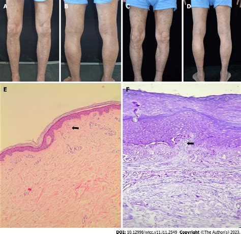 PDF Successful Treatment Of Lichen Amyloidosis Coexisting With Atopic