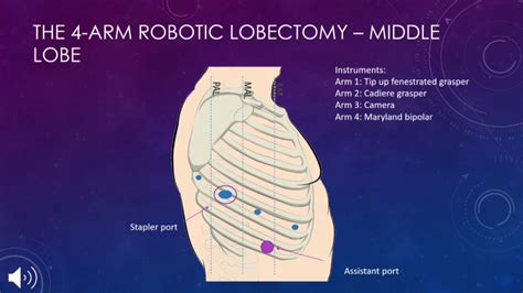 Sts U Course Robotic Lobectomy Youtube