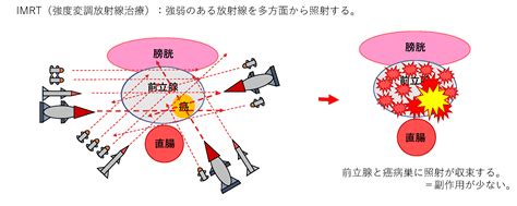 前立腺癌の放射線治療imrt（強度変調放射線治療）について｜診療科インフォメーション｜地方独立行政法人 東京都健康長寿医療センター