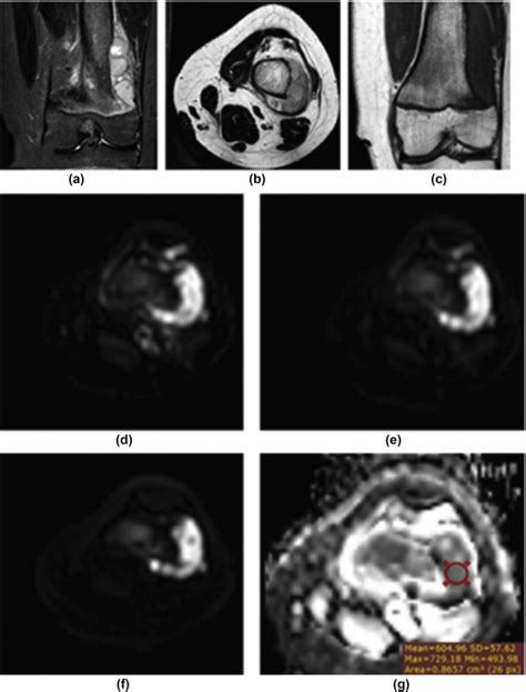 Role Of Diffusion Weighted MRI In Differentiating Between Benign And