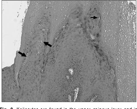 Figure 2 From A Clinicopathological Review Of Verruca Vulgaris