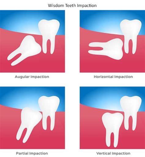 San Antonio Wisdom Teeth Removal