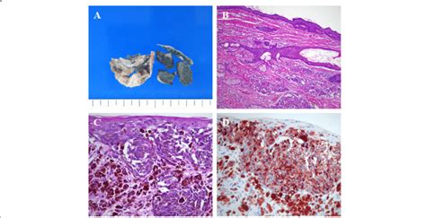 Gross And Histologic Features Of The Ovarian Cystic Mass A Dermoid