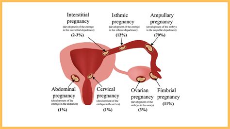 Ectopic Pregnancy After Ivf Symptoms Concerns Safety Alex Robles