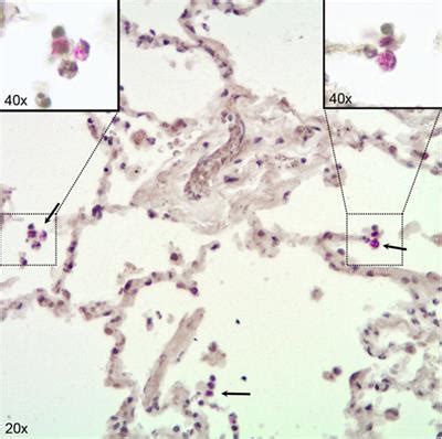 Frontiers Mycobacterium Tuberculosis Invasion Of The Human Lung