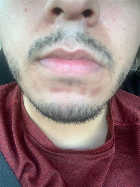 Skin rash under lip? : r/medical