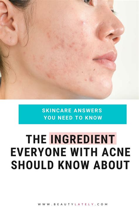 Pin On Acne Tips And Products