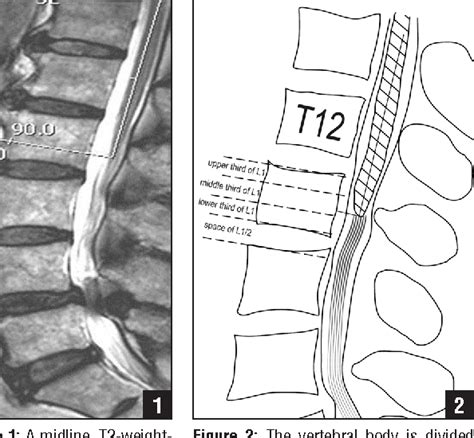 Figure 2 from MRI study of the position of the conus medullaris in ...