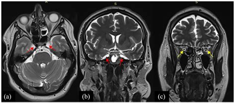 A T Weighted Axial And B And C Coronal Demonstrating A Minimal