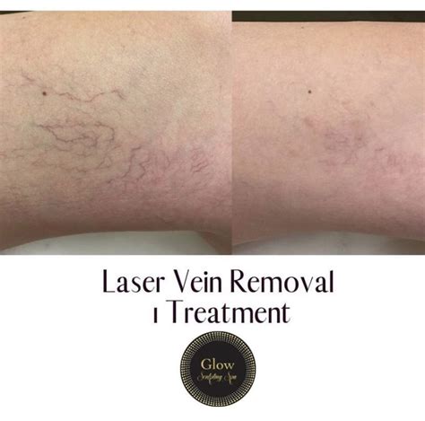 Laser Spider Vein Removal - Glow Laser Aesthetics