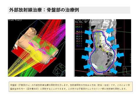 放射線治療は“がん治療の三本柱”の1つ｜放射線アカデミア