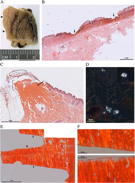 Histological Analysis Of Case 2 A Macroscopic Aspect Of The Skin