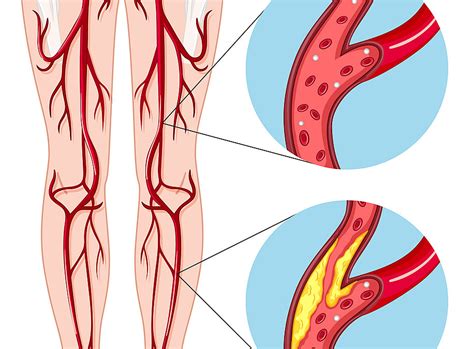 Peripheral Artery Disease Vascular And Vein Center Of New Jersey