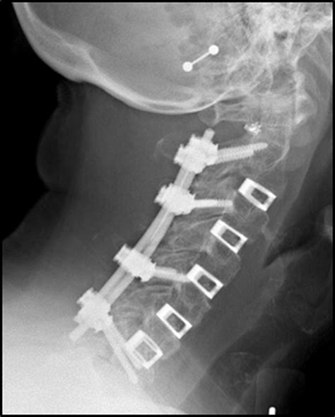 Spinal Reconstruction and Fusion_4 | Guilford Orthopaedic - Greensboro, NC