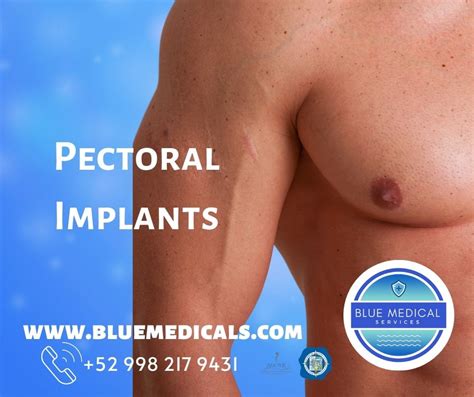 Male Pectoral Implants In Cancun Top Plastic Surgeon In Mexico