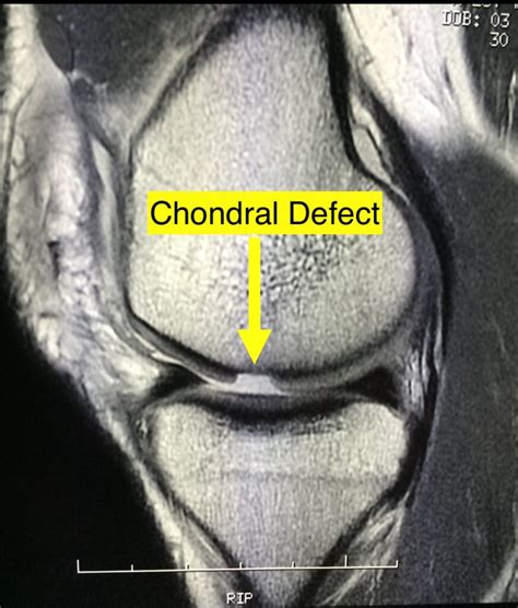 Chondral Grafting in the knee - Orthosports