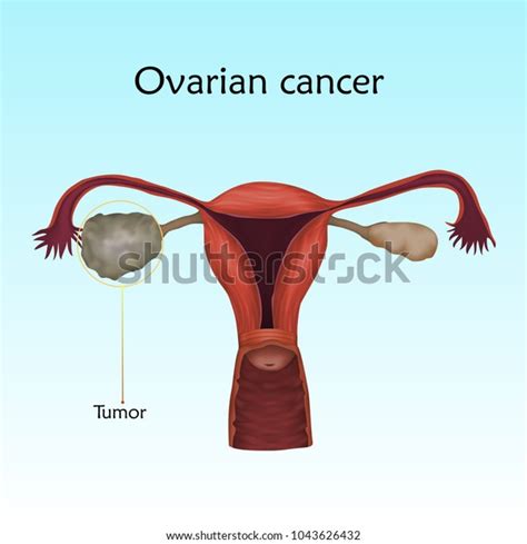 Ovarian Cancer Human Realistic Uterus Anatomy Vector De Stock Libre