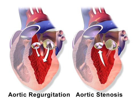 Aortic Valve Disease Physiopedia