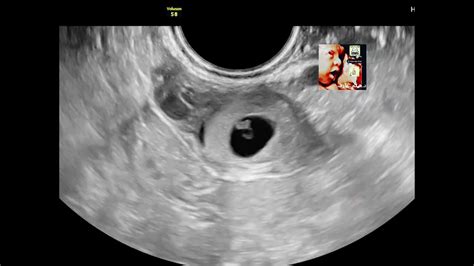 Bagel Sign In Ectopic Pregnancy Ultrasound By Drhaissam Aref Dms Msc