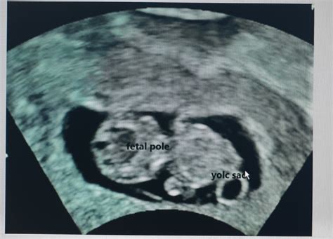Fetal Sex Prediction Measuring Yolk Sac Size And Yolk Sacfetal Pole