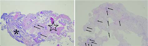 Pathological Findings Hematoxylin And Eosin Stain Of Surgical