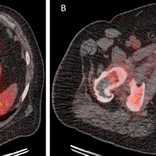 A Axial Fused PET CT Image Of 73 Year Old Male Showing A Highly FDG