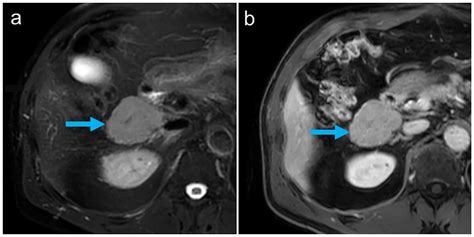 High Resolution Splenic Imaging 68ga Ga Oxine Red Blood Cell Petct