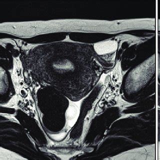 A C Pelvic Magnetic Resonance Imaging A Sagittal T Weighted