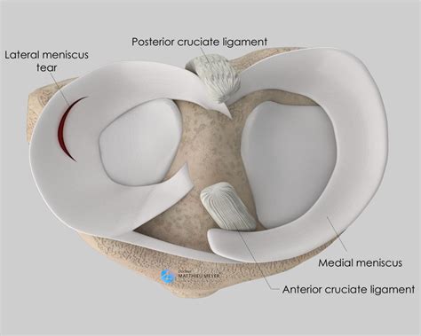 Arthroscopic Meniscal Surgery Doctor Matthieu Meyer