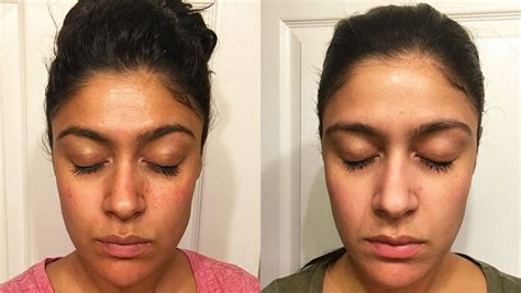 Contour Dermatology Vi Peel Before And After Results