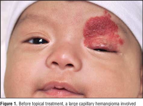 Capillary Hemangioma